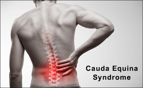 Ayurvedic Treatment For Cauda Equina Syndrome With Herbal Remedies