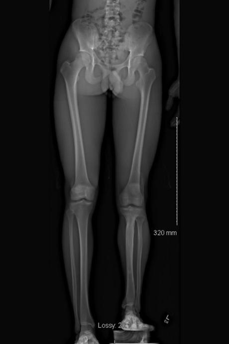 Leg Length Discrepancy (LLD)