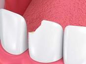 Dental Procedures Repair Your Cracked Tooth