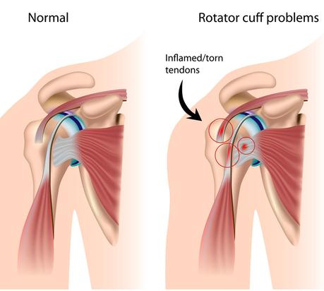 Physiotherapy Of Shoulder Impingement Syndrome