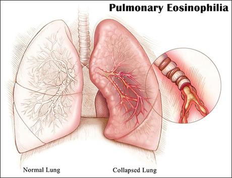 Ayurvedic Perspective of Eosinophilic Lung Disease/Pulmonary Eosinophilia
