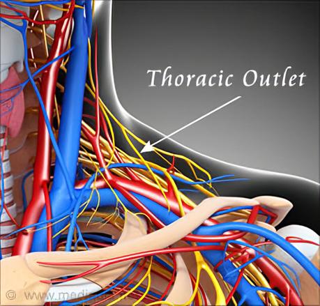 Thoracic Outlet Syndrome