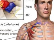 Thoracic Outlet Syndrome