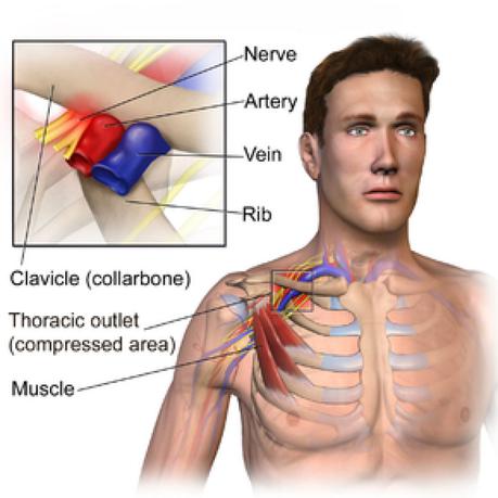 Thoracic Outlet Syndrome