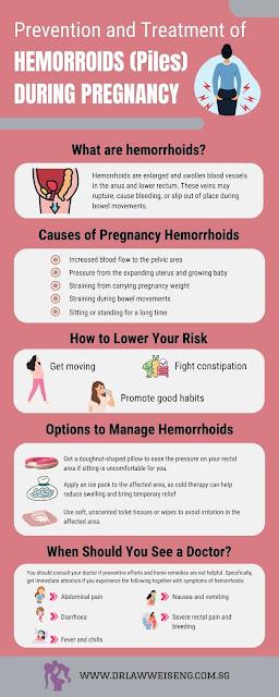 Prevention and Treatment of Hemorrhoids (Piles) During Pregnancy