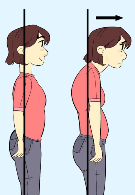 Forward Head Posture