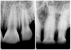 The teeth of a young (left) and old (right) chimp; showing how more of the tooth becomes exposed as to compensate for it being worn down