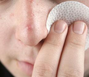 Acne Treatments*