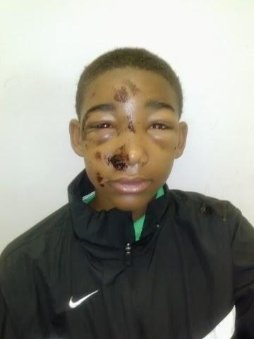 A 14yr Old Severely Tazed and Beaten By Police
