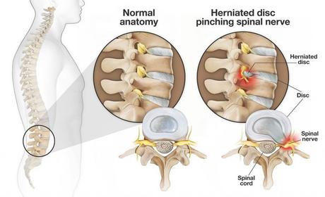 How to Fix a Pinched Nerve in the Neck