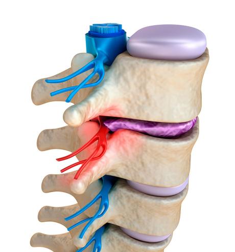 How to Fix a Pinched Nerve in the Neck