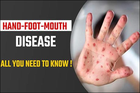 Ayurvedic Treatment For Hand, Foot and Mouth Disease