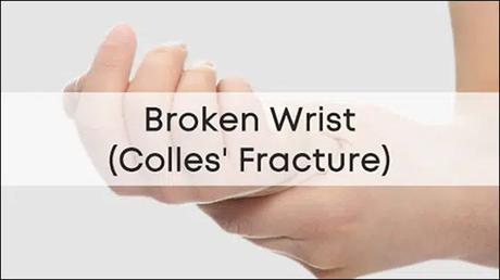 What Is Colles Fracture? – Ayurvedic Herbs for Fractures