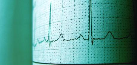 Heart arrhythmia (irregular heartbeat):  Causes, symptoms, diagnosis and treatments