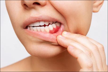 How to Treat Gum Recession Naturally Through Ayurveda