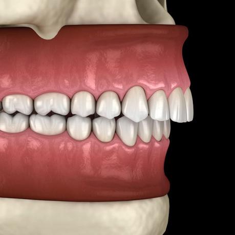 Orthodontic Treatment for Deep Bite