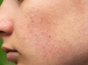 Daily Hacks: Three Surprising Natural Remedies Fighting Acne