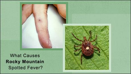 Rocky Mountain Spotted Fever (RMSF) And Its Ayurvedic Management