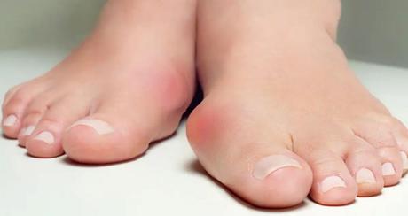 Hallux Valgus or Big Toe Deviation