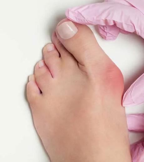 Hallux Valgus or Big Toe Deviation