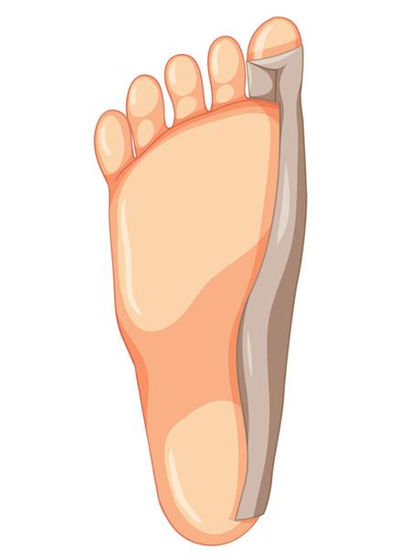 Hallux Valgus or Big Toe Deviation