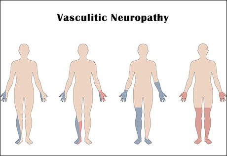 Ayurvedic Treatment Of Vasculitic Neuropathy With Herbal Remedies