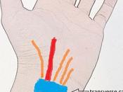 Carpal Tunnel Syndrome