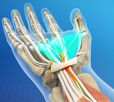 Carpal Tunnel Syndrome