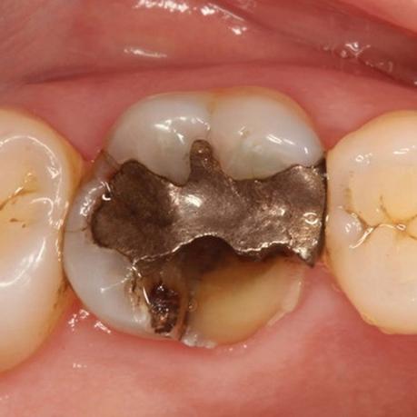 Broken Tooth Root in The Gum