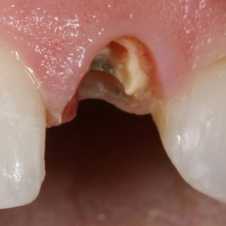 Broken Tooth Root in The Gum