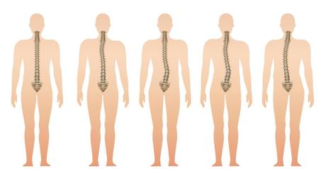 Postural Dysfunction Scoliosis