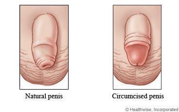 Why and When to Circumcise a Baby Boy: Report from Pediatricians Why and When to Circumcise a Baby Boy: Report from Pediatricians