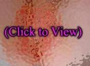 Baby Rash Pictures, Causes, Treatments