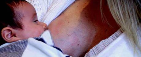 Breast Engorgement During Breastfeeding
