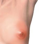 Clogged Milk Ducts While Breastfeeding Clogged Milk Ducts While Breastfeeding