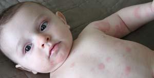 Allergies in Babies and Toddlers