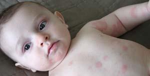 Allergies in Babies and Toddlers Allergies in Babies and Toddlers