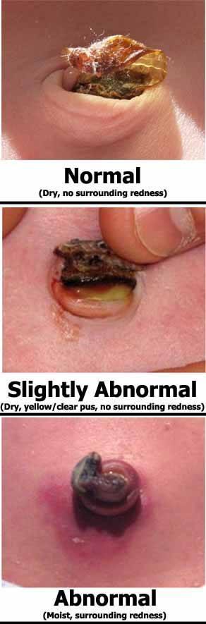 Taking Care of the Umbilical Cord Taking Care of the Umbilical Cord