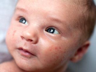 All About Baby Acne