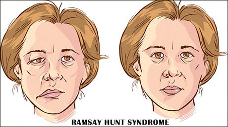 Ayurvedic Treatment For Ramsay Hunt Syndrome With Remedies