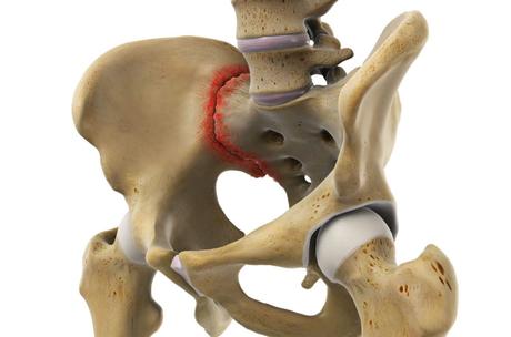 Sacroiliac Joint Dysfunction