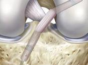 Anterior Cruciate Ligament (ACL) Injuries