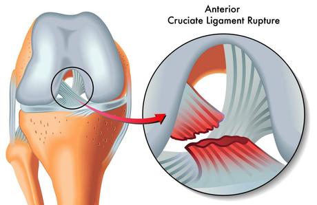 Anterior Cruciate Ligament (ACL) Injuries