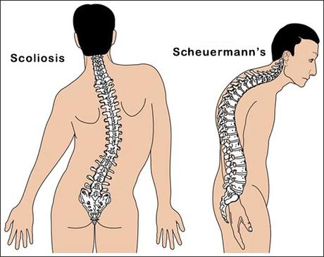 What is the difference between Scheuermann’s disease and scoliosis?
