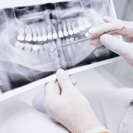 Tooth decay: Symptoms, causes, treatment