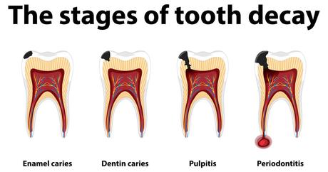 Tooth decay