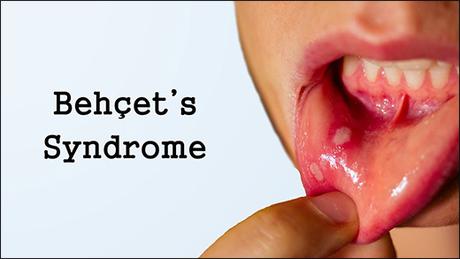 Ayurvedic Treatment For Behcet’s Syndrome With Herbal Remedies