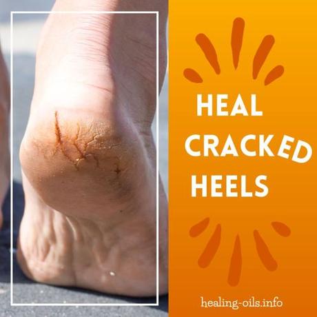How to Heal Cracked Heels