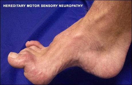 HMSN (Hereditary Motor Sensory Neuropathy) And Its Ayurvedic Management