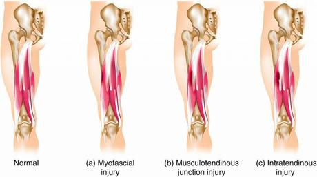 Hamstring muscle injury